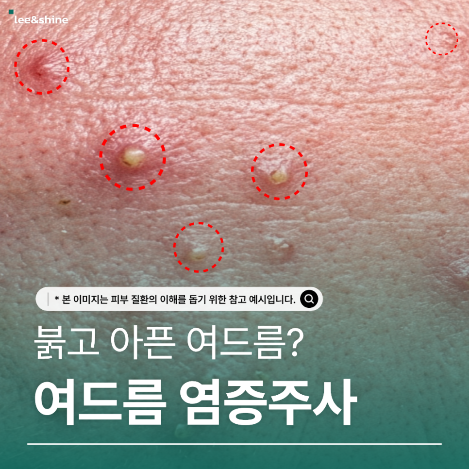 붉고 아픈 여드름과 염증주사를 소개하는 원문 이미지