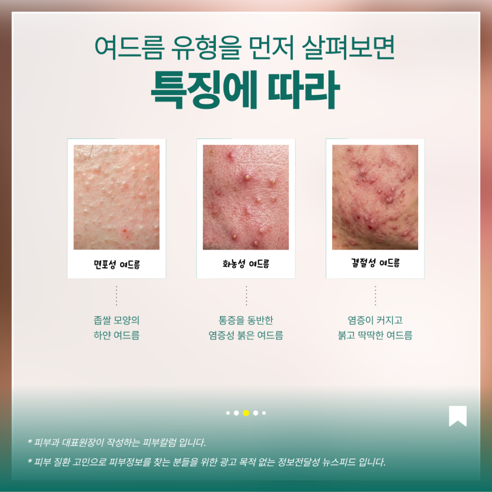 면포성·화농성·결절성 여드름의 특징을 설명하는 원문 이미지