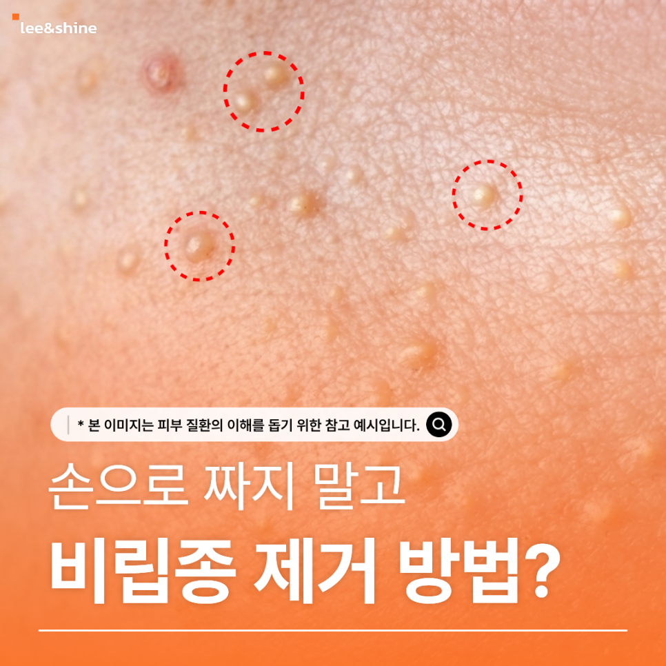 손으로 짜지 말고 비립종 제거 방법을 알아보자는 원문 안내 이미지