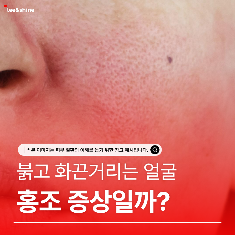 얼굴 붉어짐과 홍조를 소개하는 원문 이미지