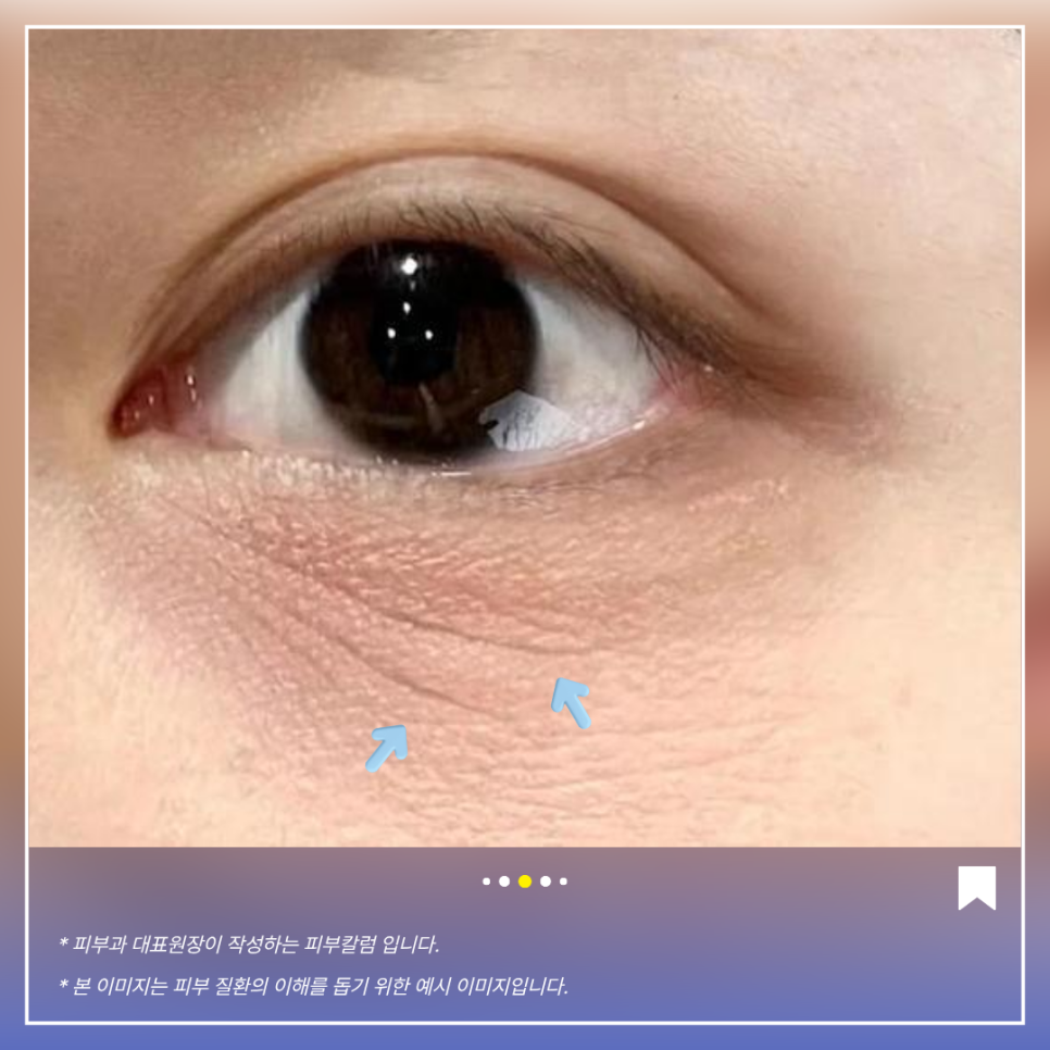 눈가 잔주름의 위치를 보여주는 원문 참고 이미지